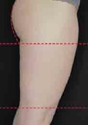 Try Emsculpt for free and experience a non-invasive way to sculpt your body with FDA clearance.