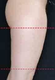 Try Emsculpt for free and experience a non-invasive way to sculpt your body with FDA clearance.