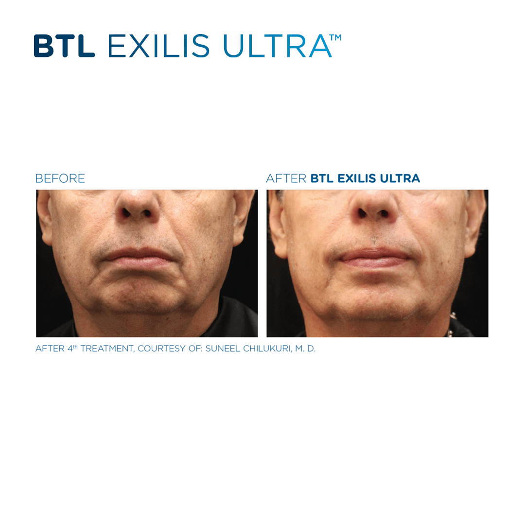 Experience advanced skin tightening and cellulite reduction with the non-invasive Exilis Ultra 360 treatment.