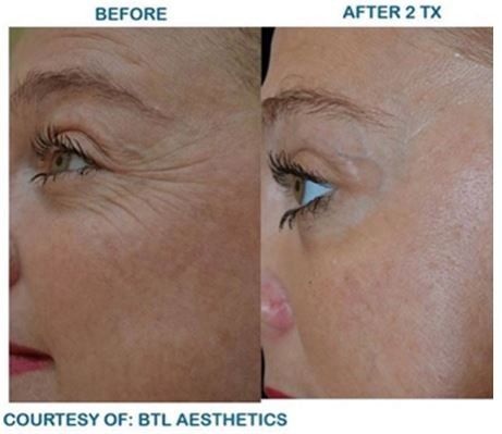 MD consultations are always free at Dr. Mantor's Wrinkle and Weight Solutions, LLC in Westerville, OH.