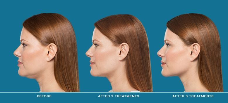 Dr. Mantor's Wrinkle and Weight Solutions, LLC - Westerville, Oh - Medical spa - kybella reduce chin