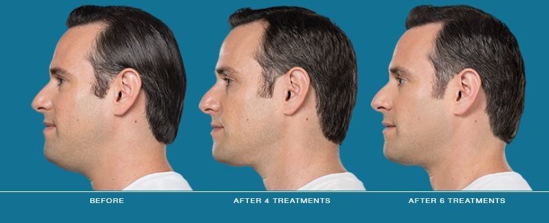 Dr. Mantor's Wrinkle and Weight Solutions, LLC - Westerville, Oh - Medical spa = kybella for men