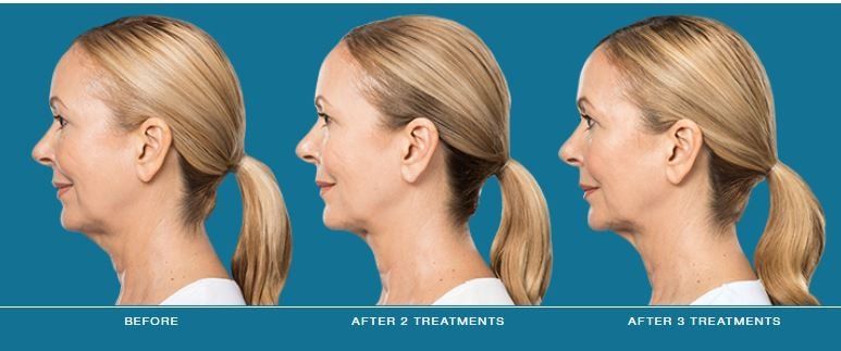 Dr. Mantor's Wrinkle and Weight Solutions, LLC - Westerville, Oh - Medical spa - kybella chin reduction