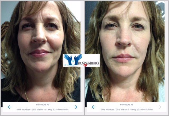 BOTOX — Before And After Cosmetic Procedure in Westerville, Ohio
Dr. Mantor's Wrinkle and Weight Solutions, LLC 