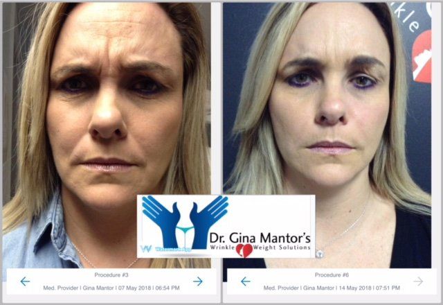 Check out Dr. Mantor's BOTOX treatment for frown lines in Westerville, OH, and see amazing results.