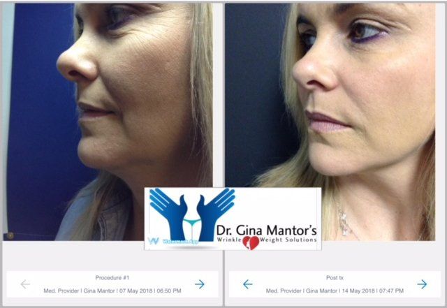 BOTOX Before And After Crows Feet Procedure in Westerville, OH.
Dr. Mantor's Wrinkle and Weight Solutions, LLC 