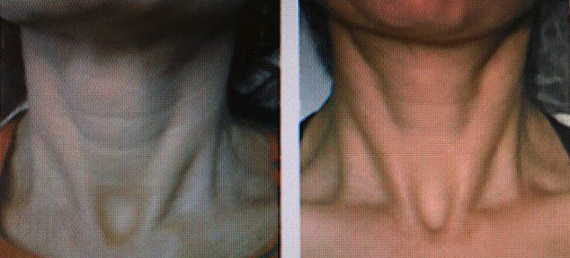 PDO Thread Lift by Dr. Gina Mantor in Westerville, OH. Free MD consultations always available.