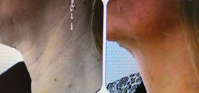Get a PDO Thread Lift with Double-Board certified Dr. Gina Mantor in Westerville. Free consults!