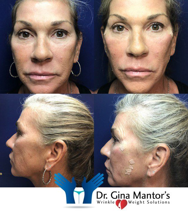 Rejuvenation — Thread Lift Thread lift results preformed by Double-Board certified Physician