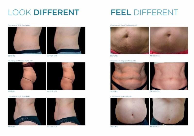Born fat, build muscle with emsculpt body sculpting.