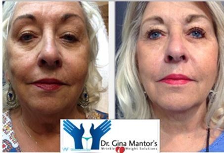 PDO thread lift - Before and After — Westerville, OH  — Dr. Mantor's Wrinkle and Weight Solutions LLC - Thread lift 