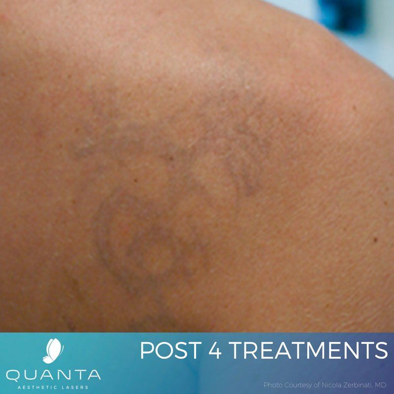 Odenton Tattoo Removal