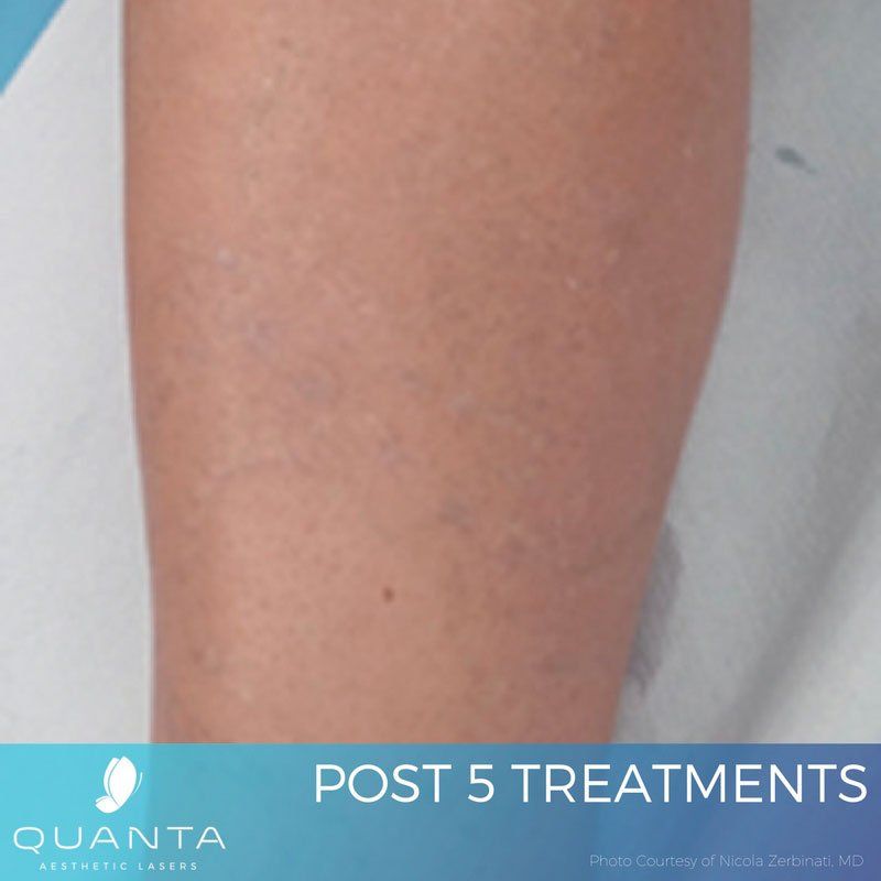 Towson Tattoo Removal