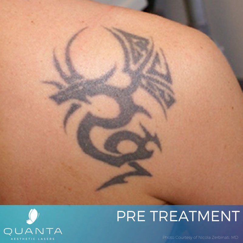 Catonsville Tattoo Removal