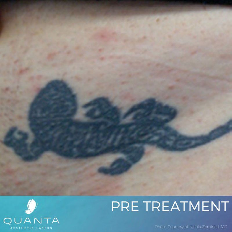 Severn Tattoo Removal