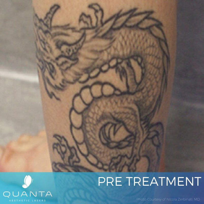 Laurel Tattoo Removal