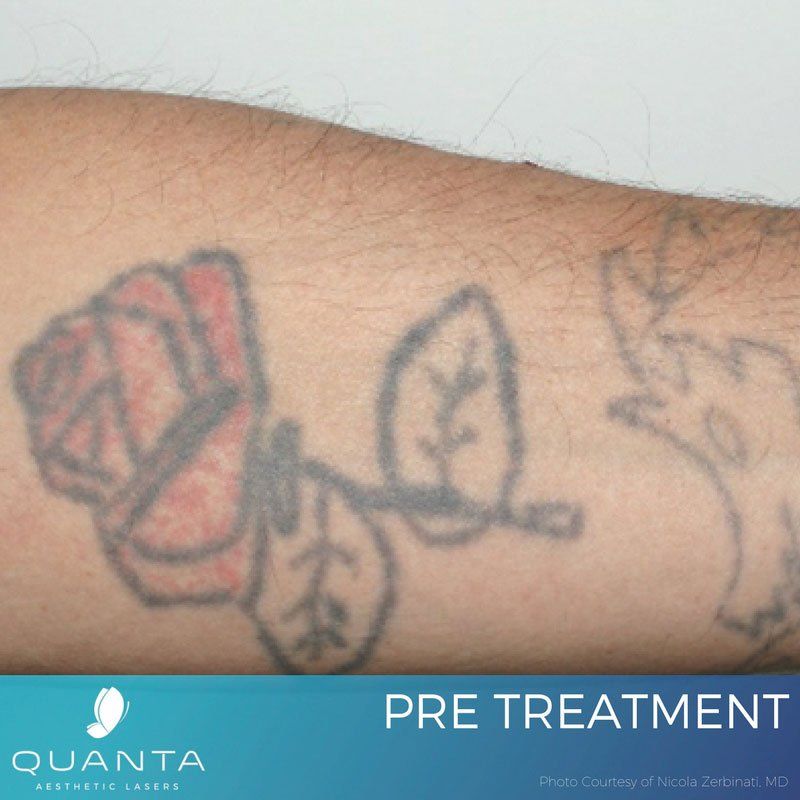 Crownsville Tattoo Removal