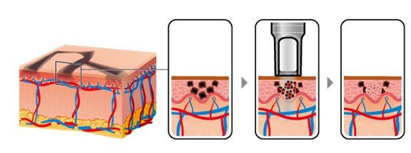 Laser Tattoo Removal Maryland Tattoo Removal
