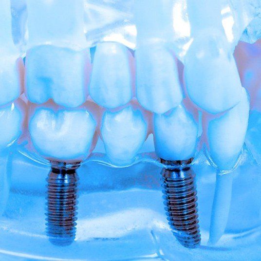 dental implants