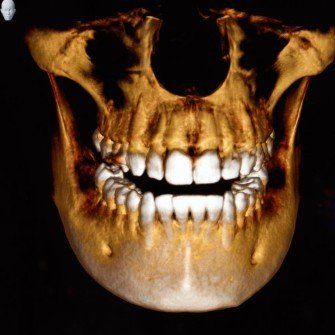 A close up of a skull and teeth on a black background.