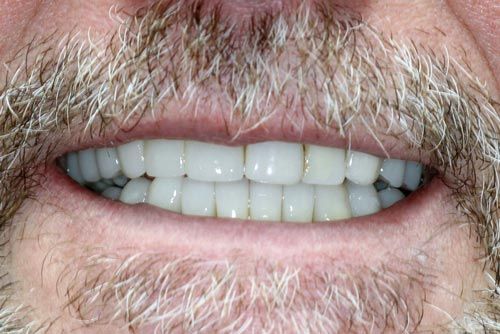 A close up of a man 's mouth with a beard and white teeth.