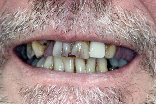 A close up of a man 's mouth with a beard and missing teeth.