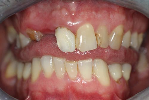 A close up of a person 's teeth with a missing tooth.