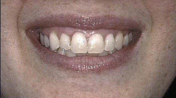 Kathryn After Invisalign
