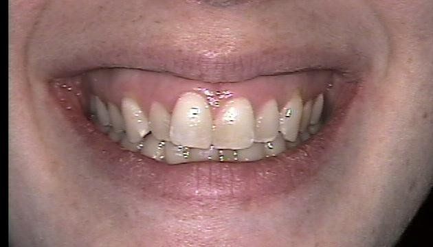 Kathryn Before Invisalign