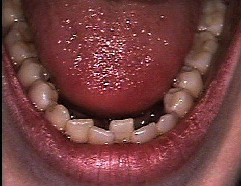 Kathryn Lower Arch Before Invisalign