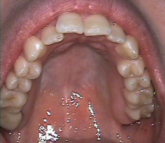 Kathryn Upper Arch Before Invisalign