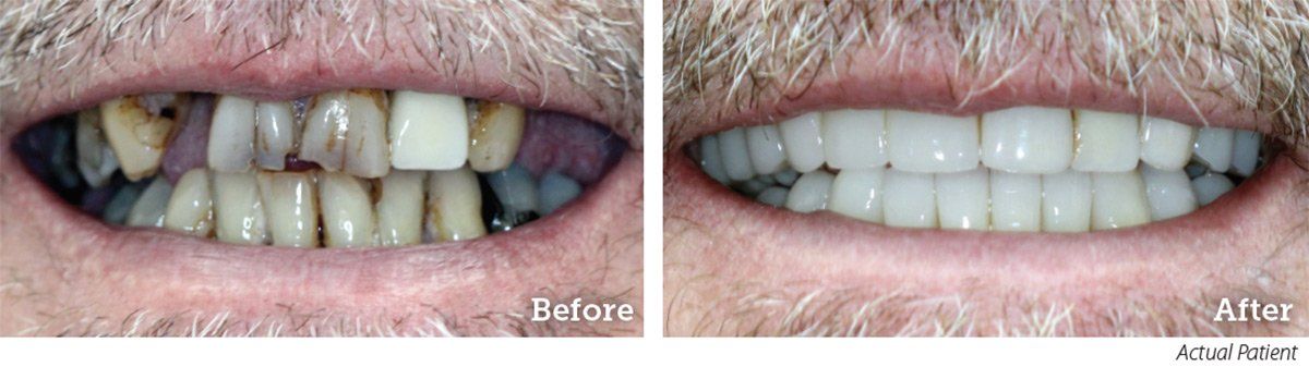 Before and After Smile Makeover