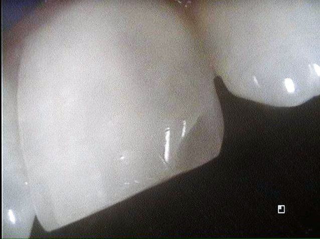 Chipped Tooth