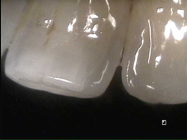 Stress Factures in Teeth