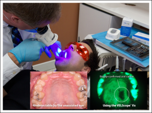 VELscope Oral Cancer Screening
