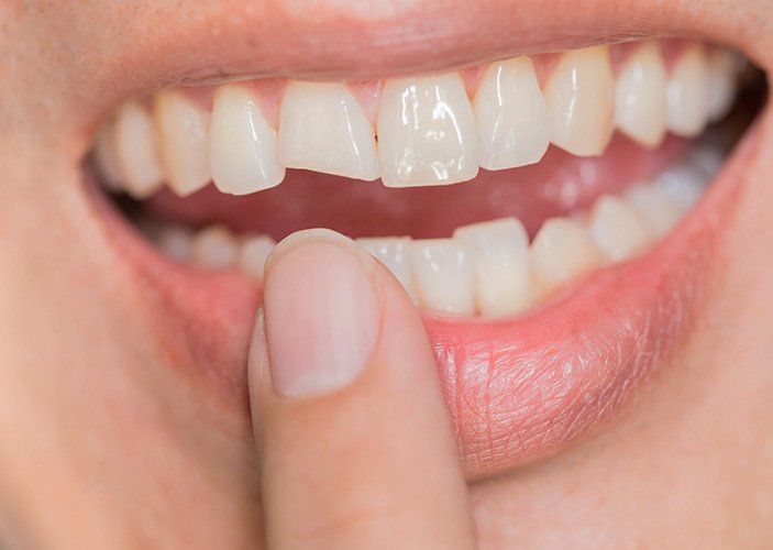 A close up of a person 's mouth with a broken tooth.