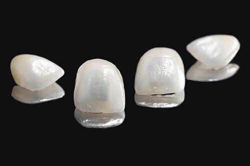 Dental Veneers - StarBrite Dental Services