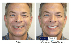A before and after picture of a man with braces smiling