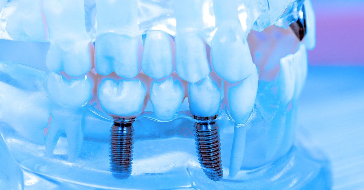 A close up of a dental model with two dental implants in it.