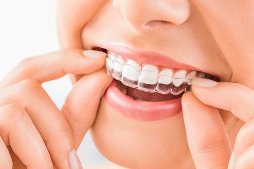 applying invisalign image