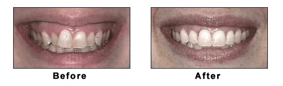 Kathryn Before and After Invisalign Photos