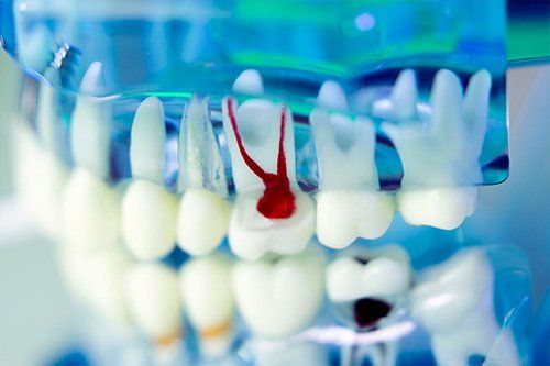 Root Canals - StarBrite Dental Services