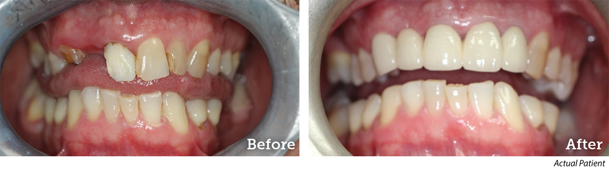 Before and After Cosmetic Dentistry