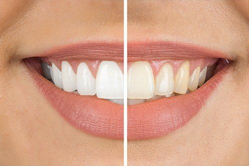 Invisalign - StarBrite Dental Services