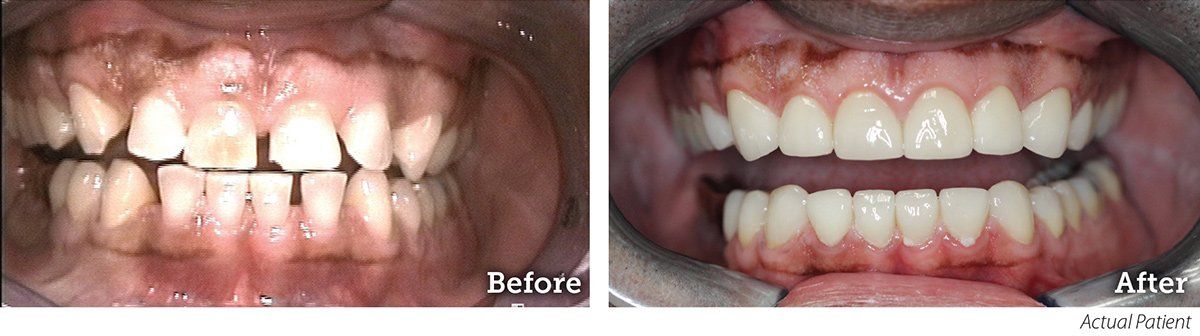 Before and After Veneers