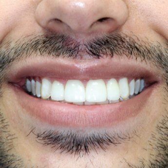 A close up of a man 's mouth with a beard and white teeth.