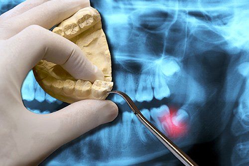 Wisdom Tooth Extractions - StarBrite Dental Services