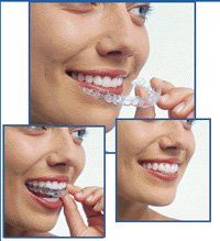 woman with clear aligners