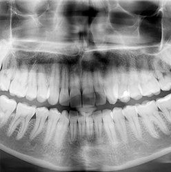 Teeth xray — Dental Implants in Springfield, PA Teeth xray — Dental Implants in Springfield, PA