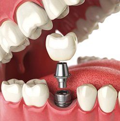 Dental implants — Dentists in Springfield, PA Dental implants — Dentists in Springfield, PA